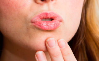 Как бороться с трещинками в уголках губ?