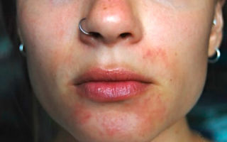 Разновидности дерматита на лице и его лечение
