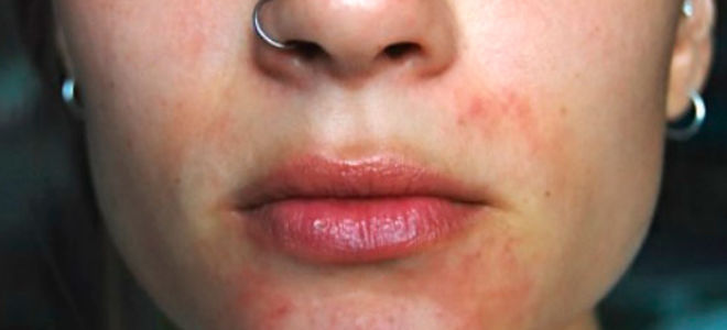 Разновидности дерматита на лице и его лечение