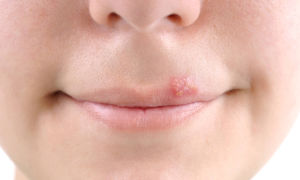 Лечение герпеса на нежной коже губ
