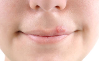Лечение герпеса на нежной коже губ