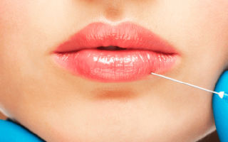 Инновационная коррекция губ с помощью липофилинга