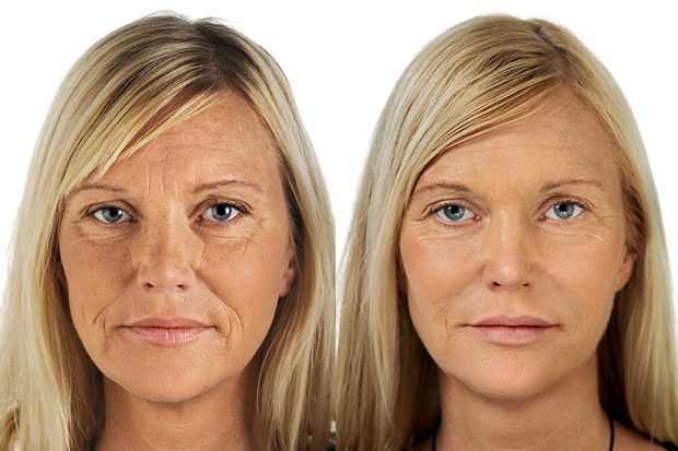 биоревитализация кожи лица