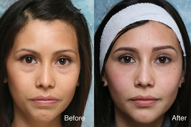 до и после блефорапластики кожи глаз