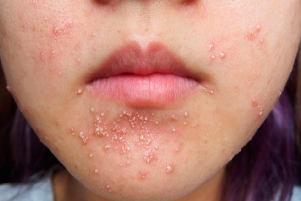 аллергические высыпания на коже