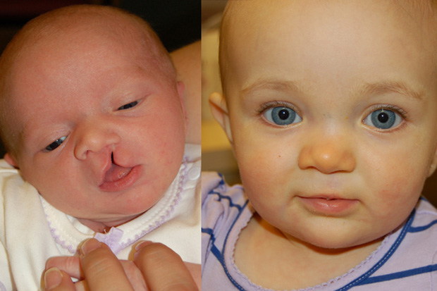 до и после операции по устранению заячьей губы