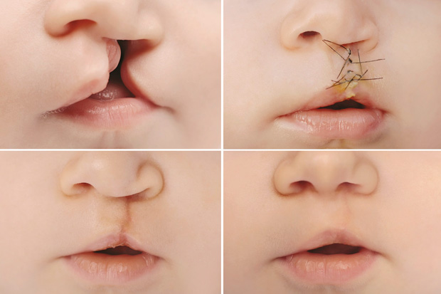 этапы реабилитации после коррекции заячьей губы